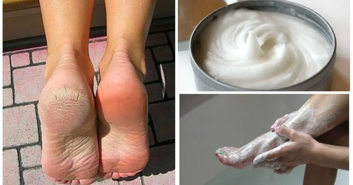 Eliminate All Calluses And Corns Feet With This Home Remedy Live The Glory 7524